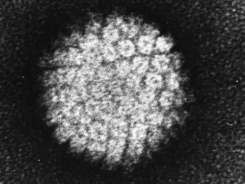 Virus HPV có thể gây ung thư tuyến tiền liệt