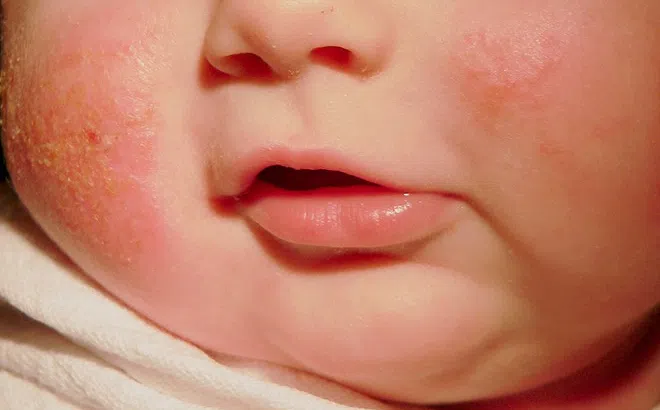 7 mẹo giảm triệu chứng ngứa do bệnh chàm từ thiên nhiên